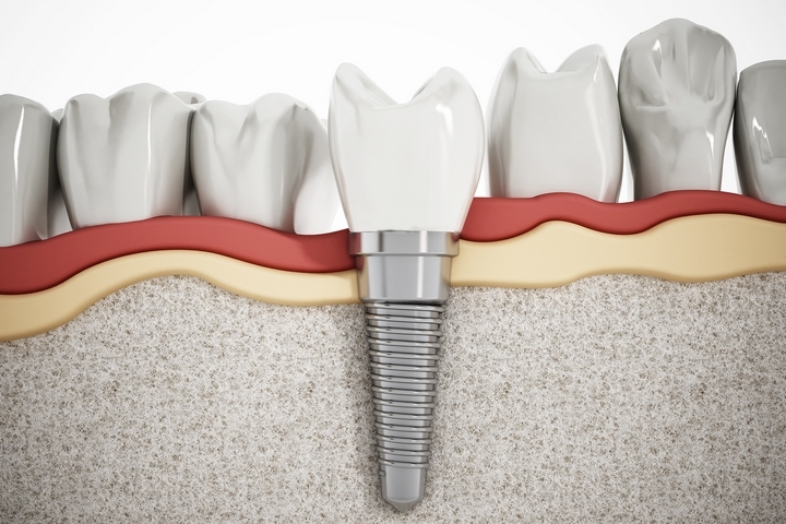 4 Methods to Take Care of Your Dental Implants