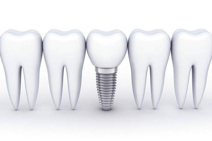 The Top 5 Advantages of Having Dental Implants