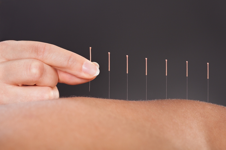 10 Surprising Acupuncture Benefits for Your Personal Health