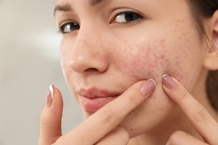 <strong>How to Get Rid of Acne Permanently</strong>